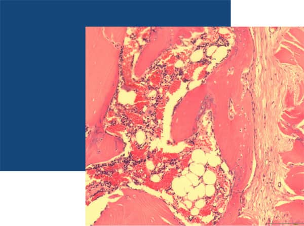 Demineralised Bone Matrix (DBM)