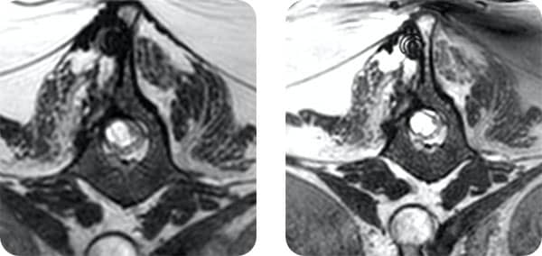 MRI pre and post transplant