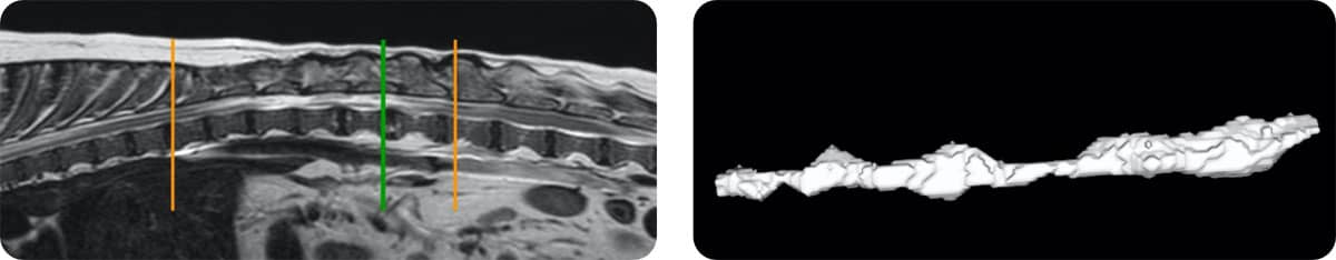 MRI lesion volume